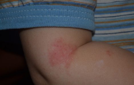 У ребенка сыпь на локтях и коленях: причины прыщиков и фото высыпаний с пояснениями