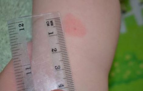 Норма размеров Манту у детей в 4 года и в 5 лет по таблице