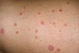 Чем лечить псориаз на руках?