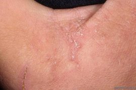 Психосоматика псориаза и способы лечения по Луизе Хей