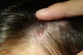 Стоит ли серьезно относиться к прыщам в носу