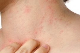 Причины возникновения псориаза, симптомы, виды, методы лечения
