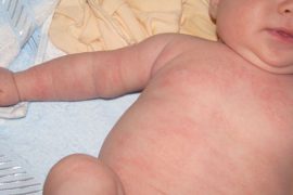 Первые признаки псориаза у детей