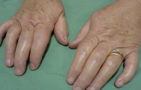 Что такое артропатический псориаз и как его лечить