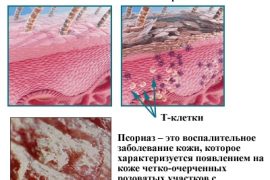 Чем лечить псориаз на теле? Как выглядит и от чего появляется, какими способами бороться с недугом? Фото