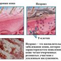 Как вылечить псориаз