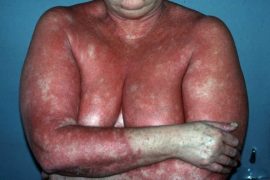 Какой врач поможет справиться с псориазом