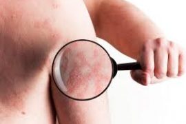 Inderma средство от псориаза — отзывы о лечении