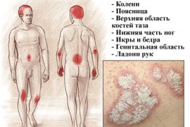 Основные причины и симптомы псориаза у взрослых