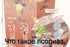 Чем опасен псориаз