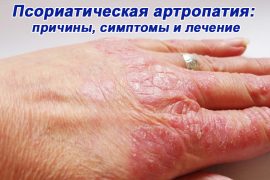 псориаз артропатия