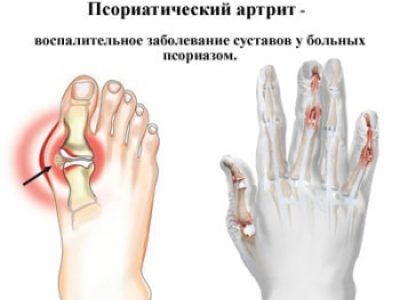 Псориатический артрит