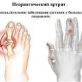 Псориатический артрит: симптомы и лечение