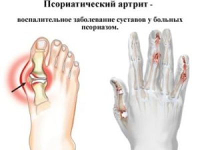 Псориатический артрит и методы его лечения