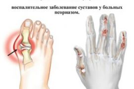 Псориатический артрит что это такое