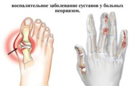 Псориатический артрит что это такое