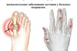 Псориатический артрит