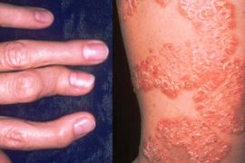 Все о лечении псориатического артрита