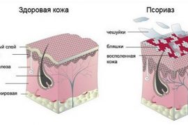 Псориаз