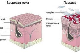 Анализы и диагностика псориаза