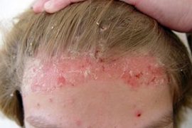 Псориаз: симптомы, стадии, как лечить