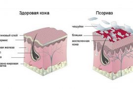 Псориаз волосистой части головы