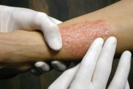 Основные причины псориаза, виды и методы лечения
