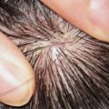 Фото псориаза по стадиям