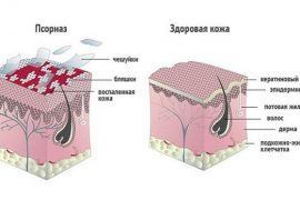 Признаки и симптомы псориаза