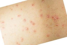 Капельный (каплевидный) псориаз – одна из форм чешуйчатого лишая