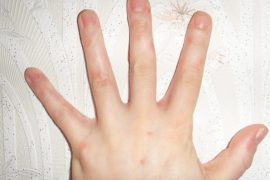 Начальная стадия псориаза на руках