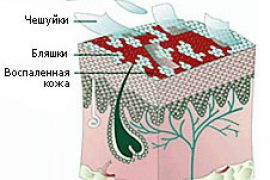 Какие современные способы и методы эффективного лечения кожных болезней и псориаза существуют