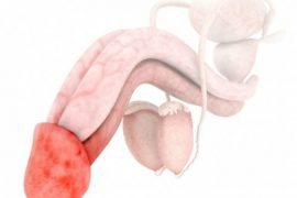 Как выглядит псориаз на половом члене и головке? Методы лечения, причины и симптомы