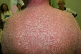 Что делать если при псориазе сильно отекают ноги