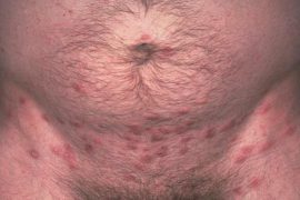 Псориаз на половых органах: симптомы, профилактика и методы лечения