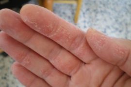 Чем лечить псориаз на руках?