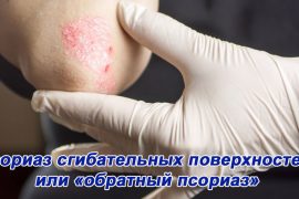 Обратный псориаз и экссудативный псориаз