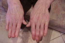 Псориатический артрит позвоночника. Что нужно знать?