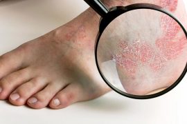 Ладонно подошвенный псориаз лечение народными средствами советы