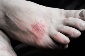 Псориаз на ногах. Как лечить псориаз на ступнях.