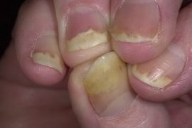 Какую мазь использовать при псориазе ногтей