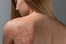 Лечебные ванны при псориазе — общие рекомендации и лучшие рецепты для домашних условий