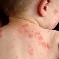 Бывает ли псориаз у детей? Как проявляется болезнь и как ее вылечить?