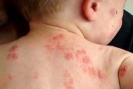 Бывает ли псориаз у детей? Как проявляется болезнь и как ее вылечить?