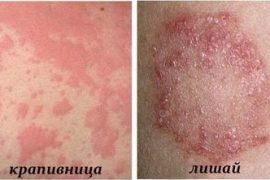 Псориаз на ногах