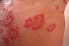 Самая эффективная в борьбе с псориазом диета Пегано, меню на неделю с рецептами