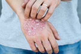 Самые лучшие народные средства от псориаза