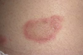 Как отличить розовый лишай и другие заболевания от псориаза