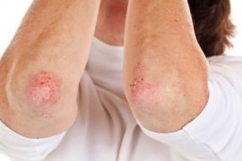 Чем лечить псориаз на руках?