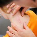 Медикаментозные и народные методы лечения псориаза